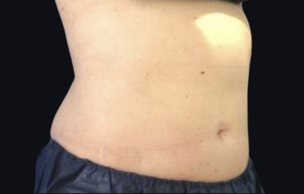 Coolsculpting® ELITE Case 34 After Image