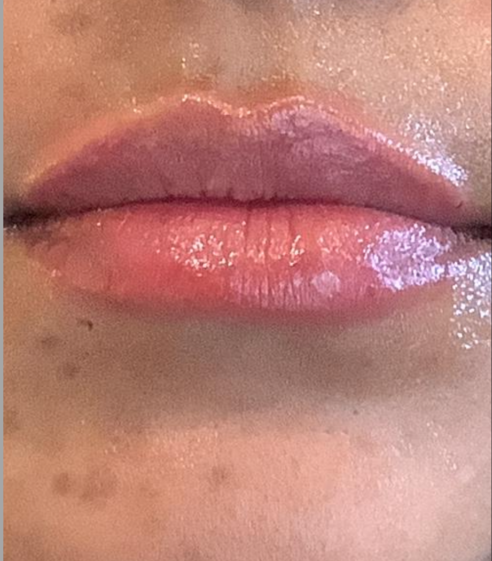 Dermal Fillers Case 34 After Image