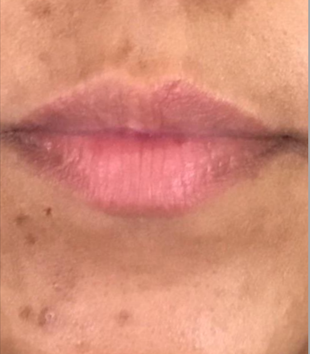 Dermal Fillers Case 34 Before Image