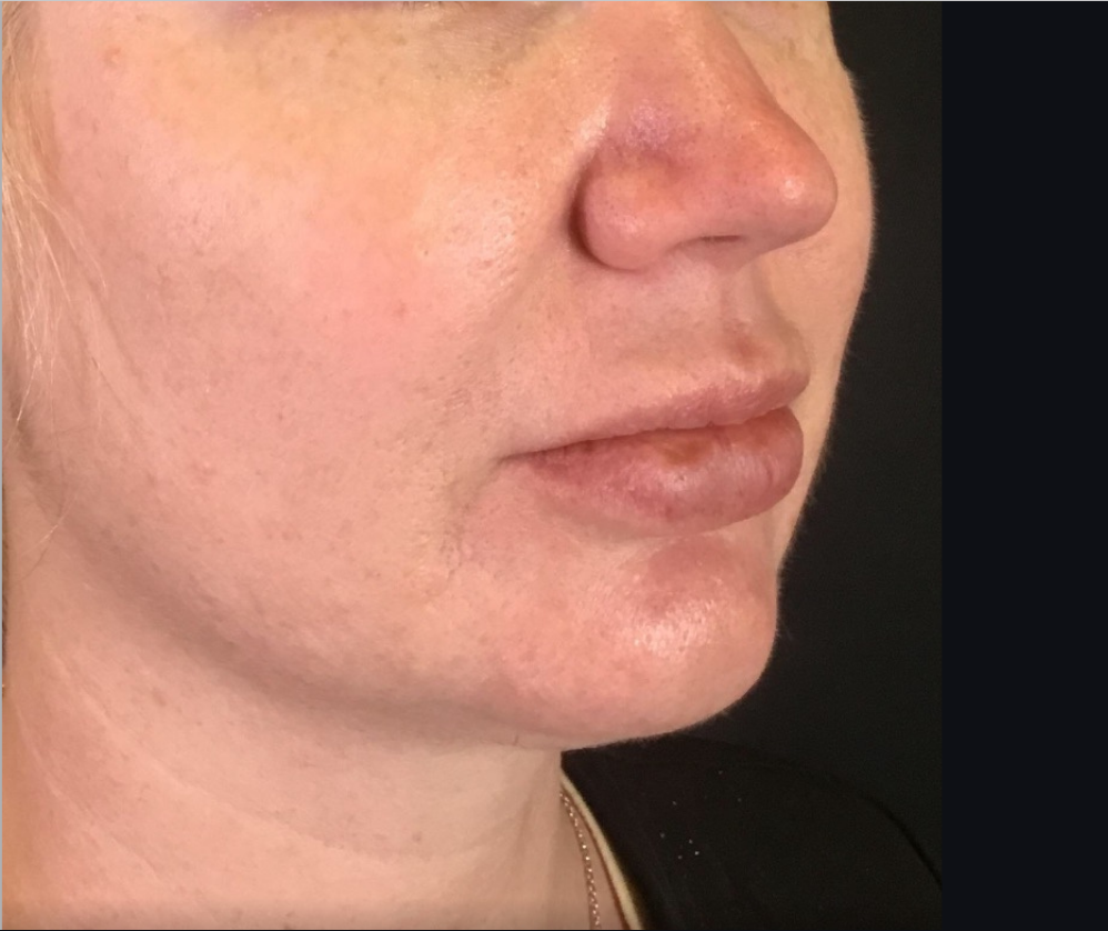 Coolsculpting® ELITE Case 35 After Image