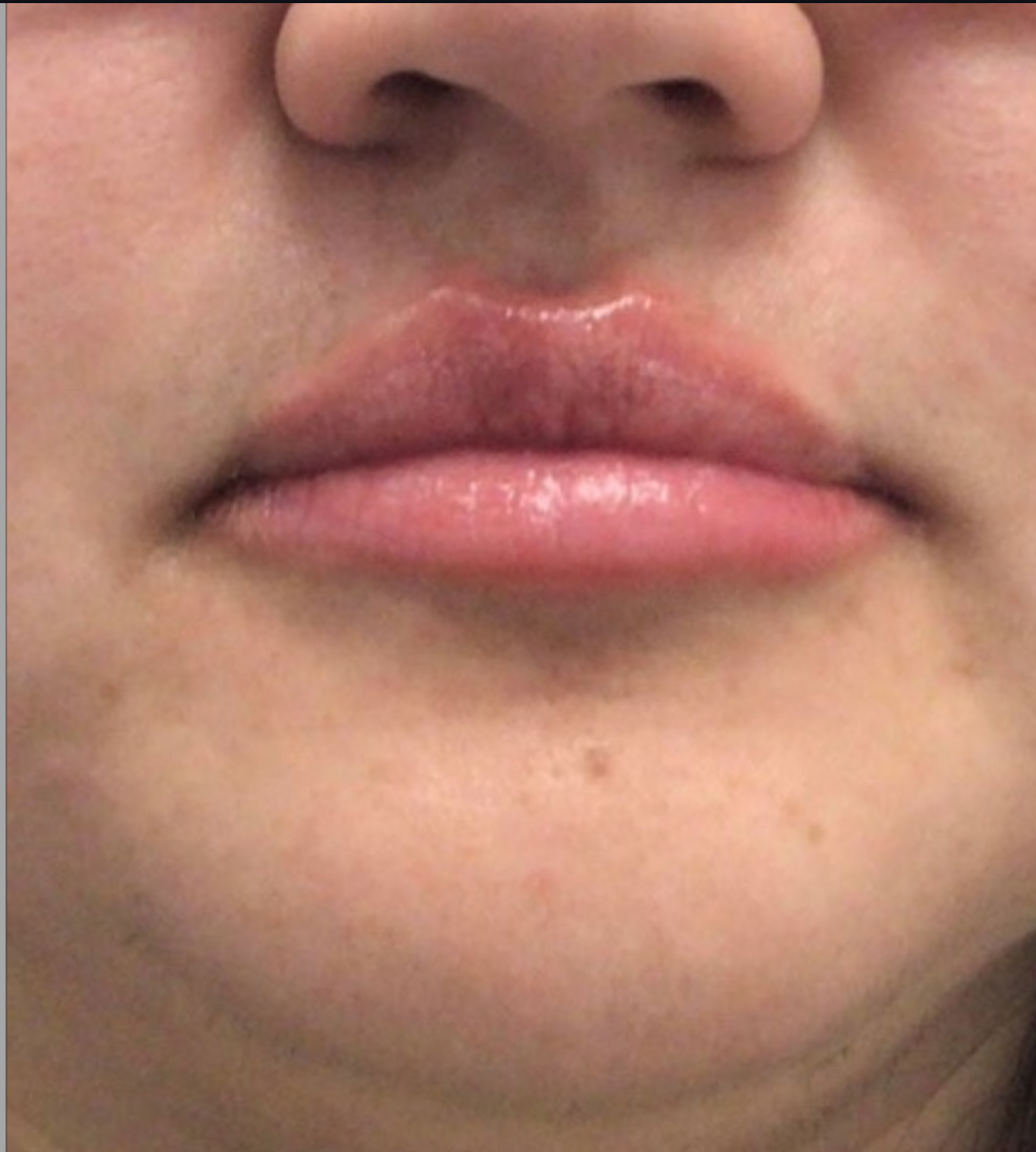 Dermal Fillers Case 35 After Image