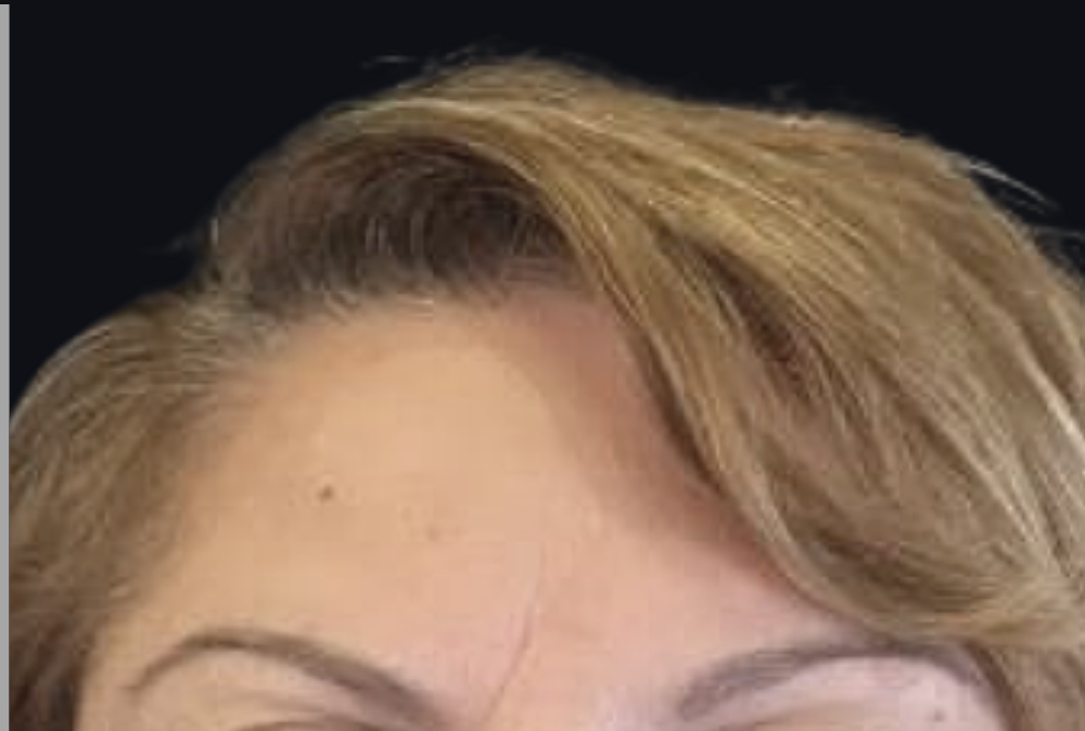 Botox® / Dysport® Case 4 After Image