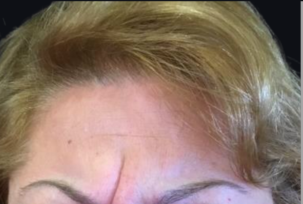 Botox® / Dysport® Case 4 Before Image