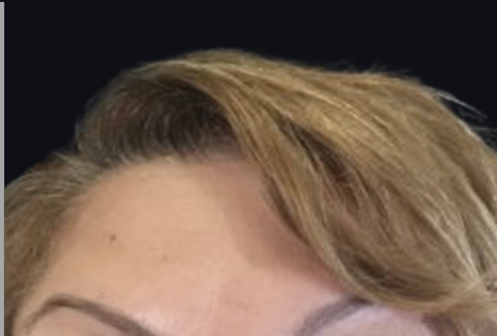 Botox® / Dysport® Case 4 After Image