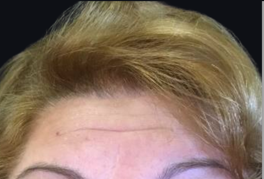 Botox® / Dysport® Case 4 Before Image
