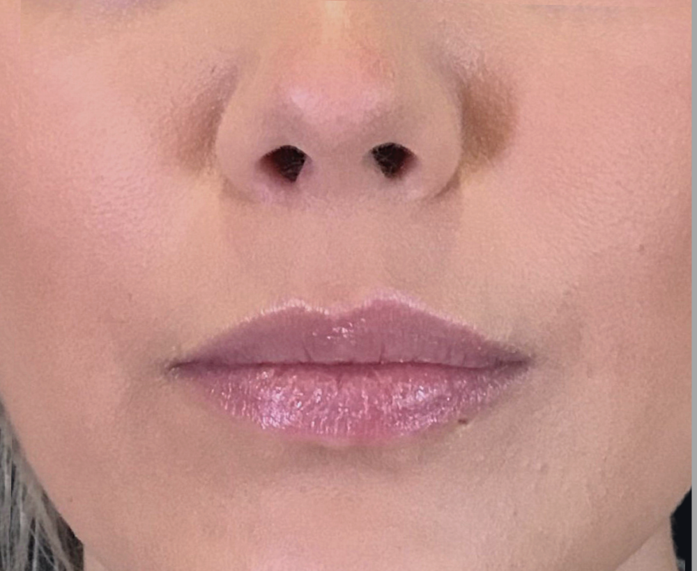 Lip Injections Case 4 Before Image