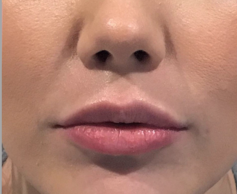 Lip Injections Case 4 After Image