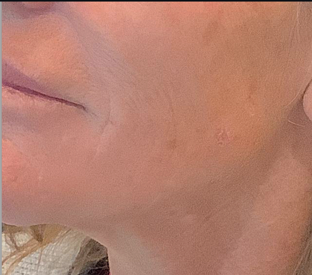 Dermal Fillers Case 40 After Image