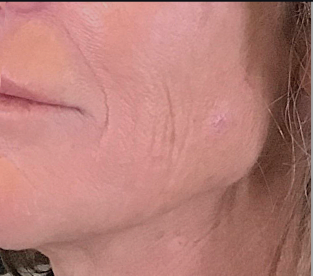 Dermal Fillers Case 40 Before Image