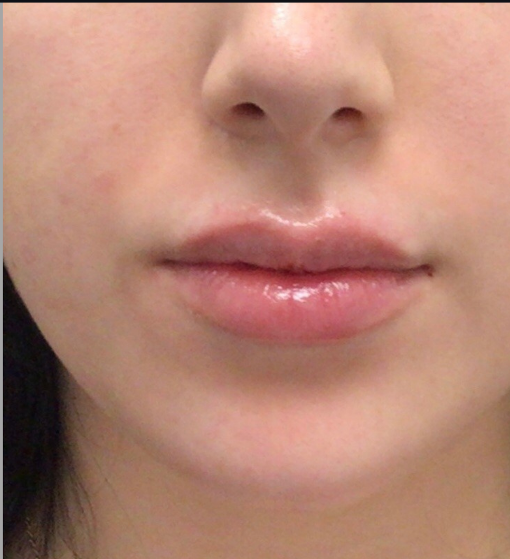 Dermal Fillers Case 41 After Image