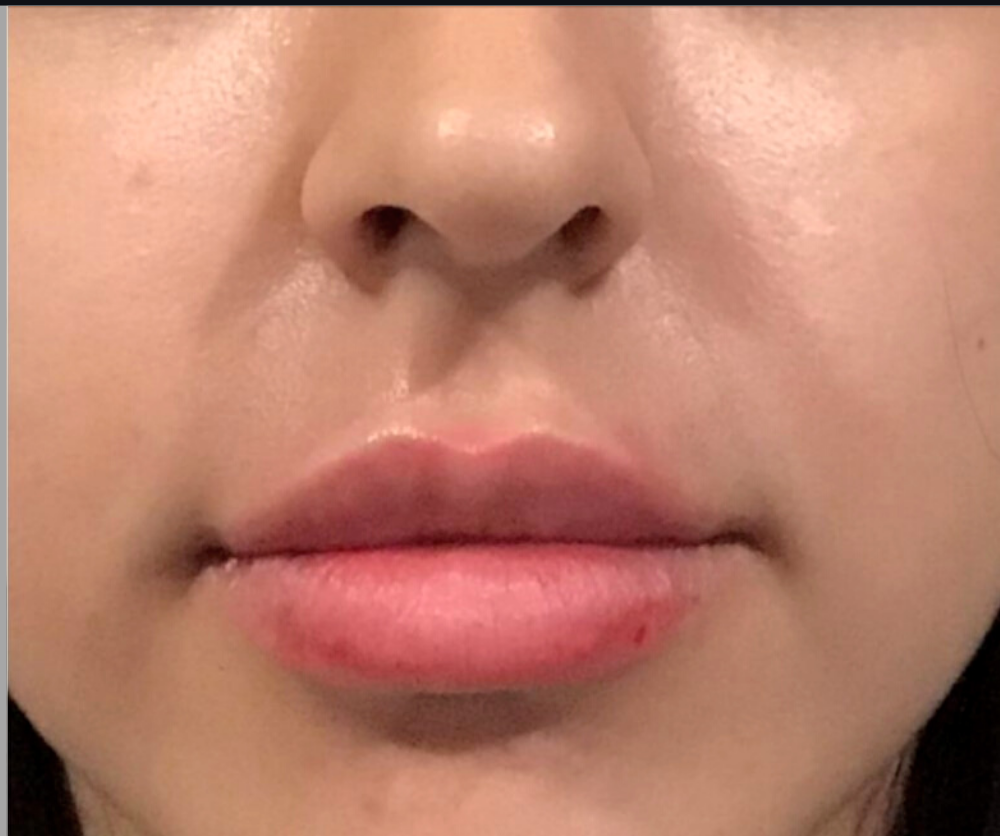 Dermal Fillers Case 42 After Image