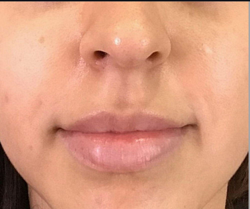 Dermal Fillers Case 42 Before Image