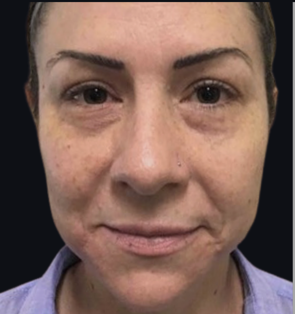 Dermal Fillers Case 44 Before Image