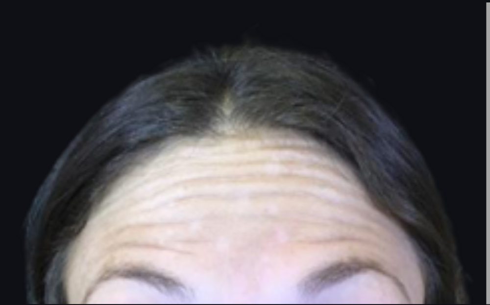 Botox® / Dysport® Case 5 Before Image