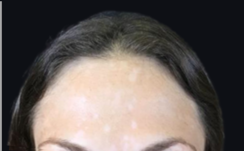 Botox® / Dysport® Case 5 After Image