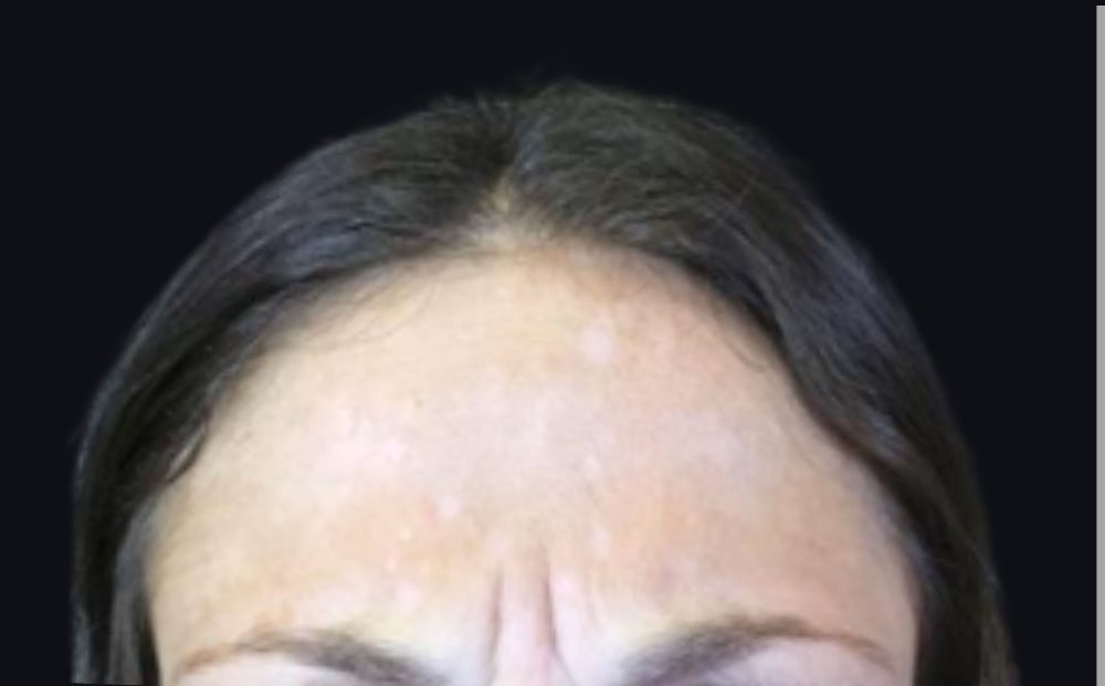 Botox® / Dysport® Case 5 Before Image