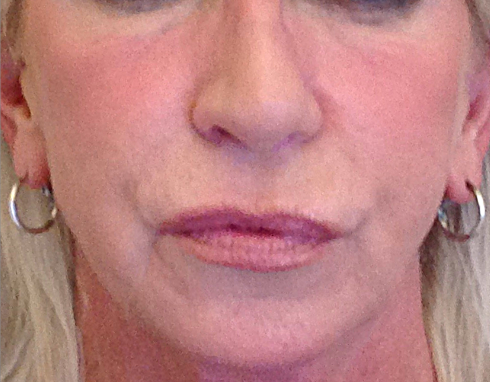 Dermal Fillers Case 5 After Image