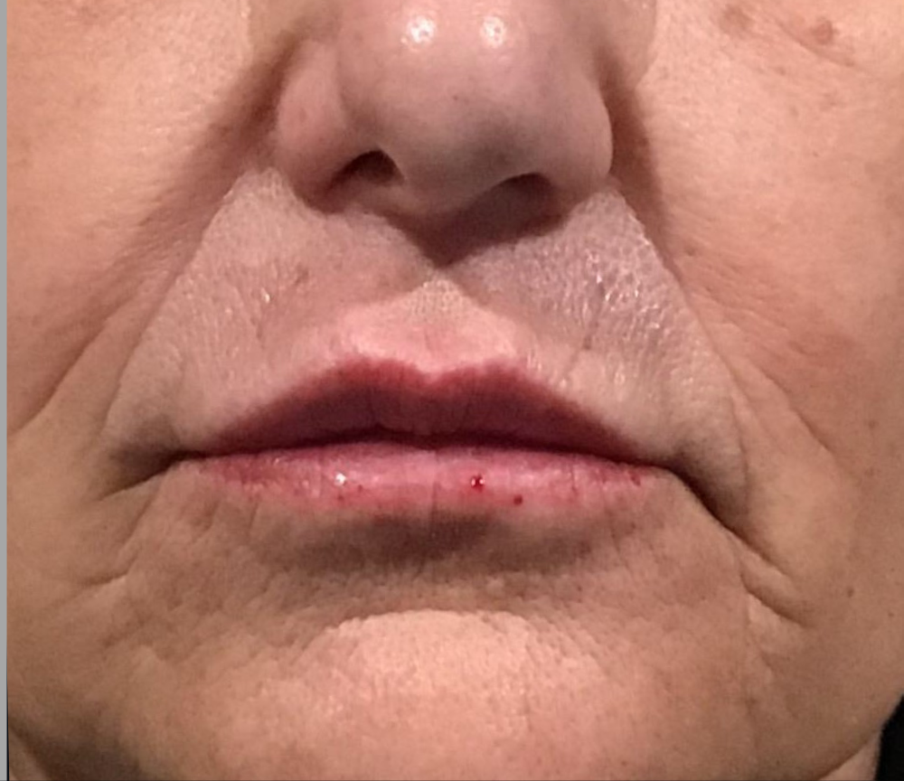 Dermal Fillers Case 6 After Image