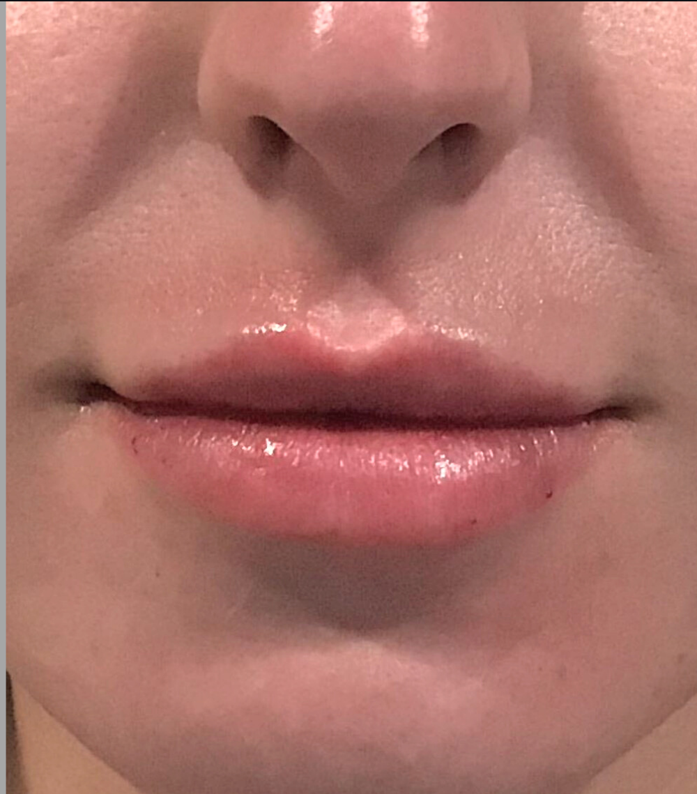 Lip Injections Case 6 After Image