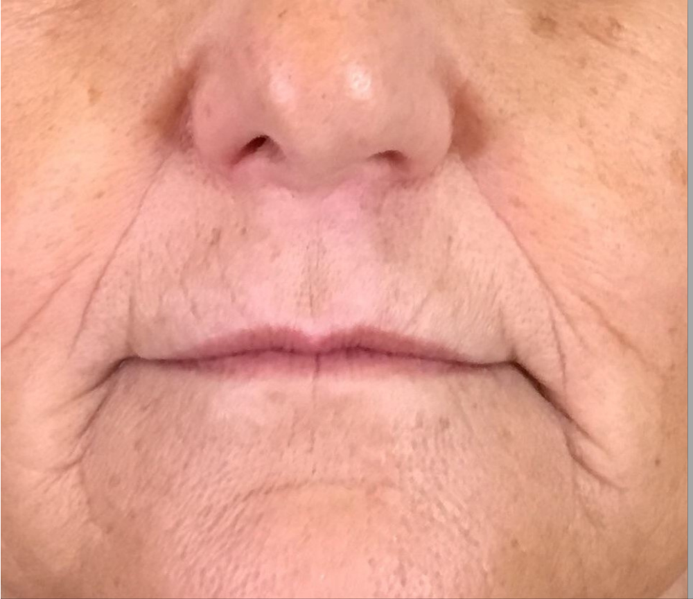 Dermal Fillers Case 6 Before Image