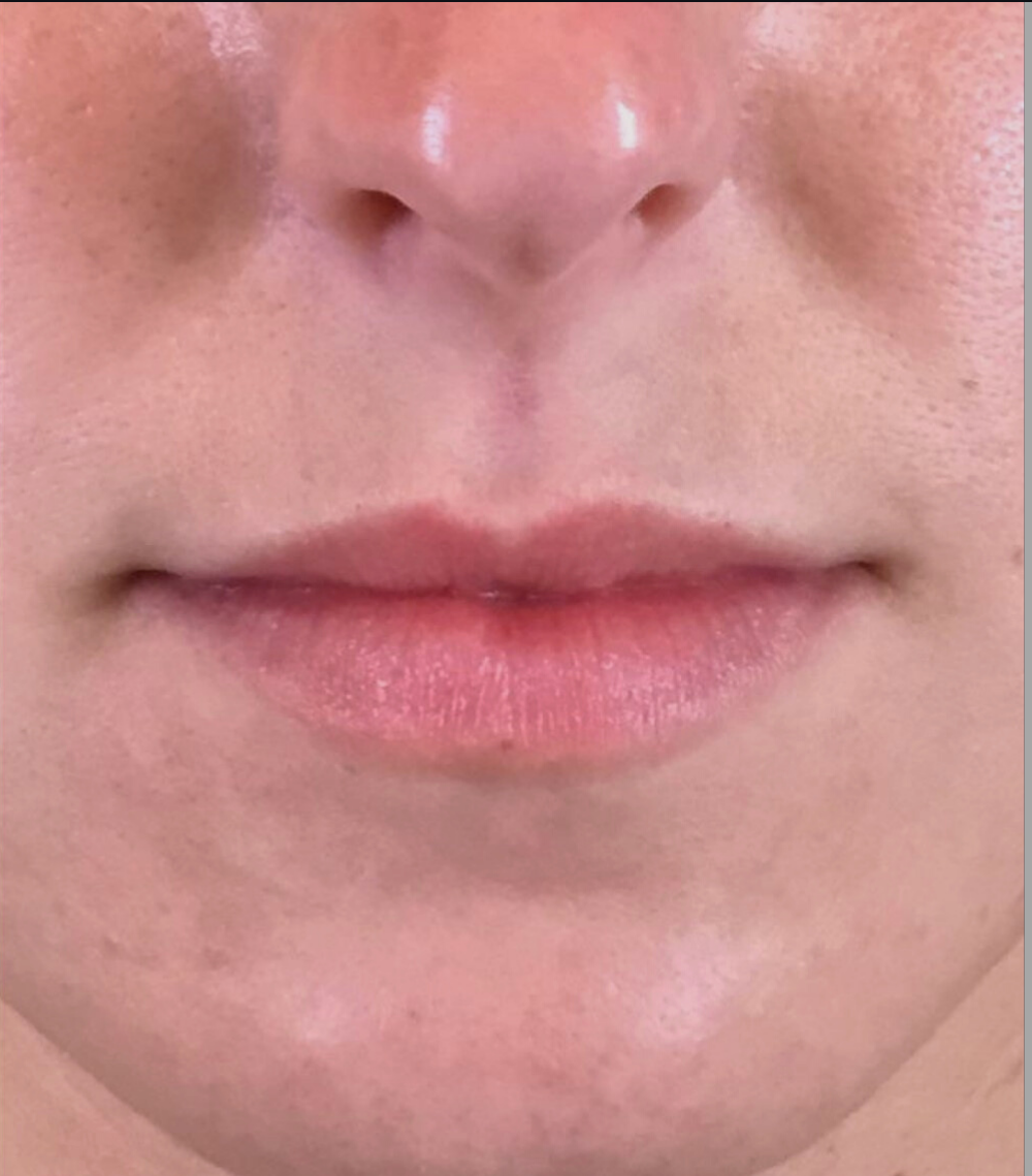 Lip Injections Case 6 Before Image