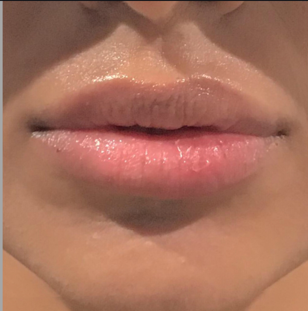 Lip Injections Case 7 After Image