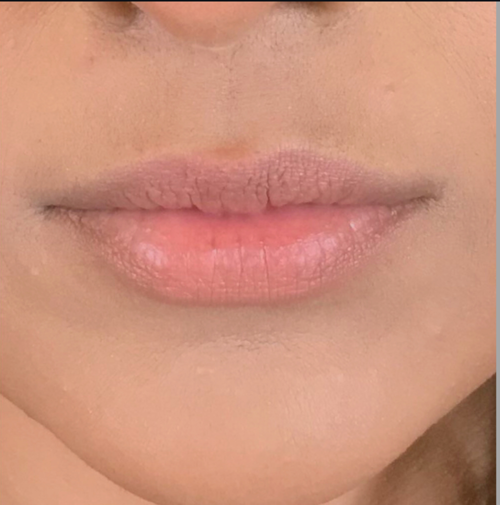 Lip Injections Case 7 Before Image