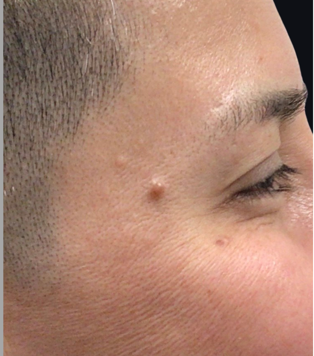 Botox® / Dysport® Case 7 After Image