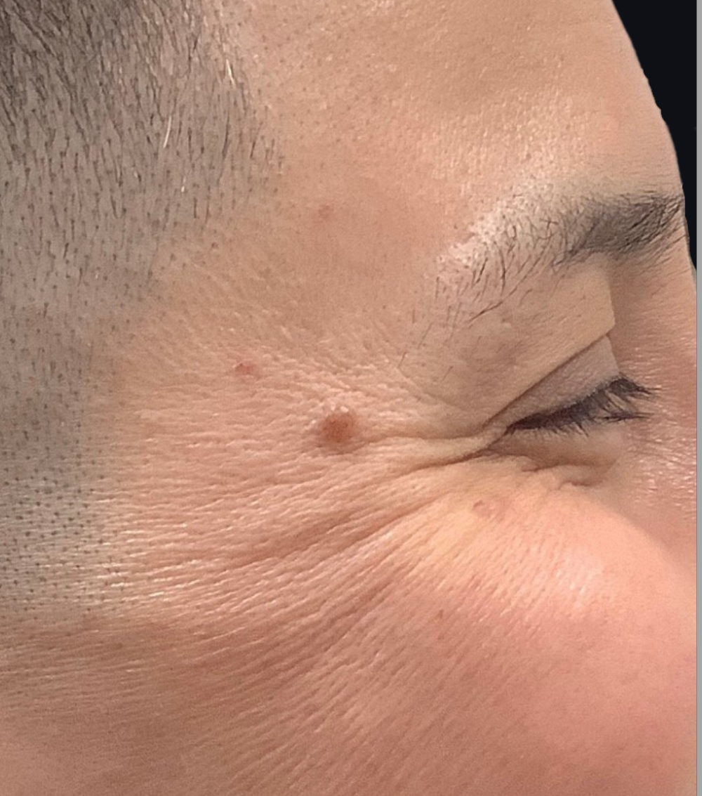 Botox® / Dysport® Case 7 Before Image