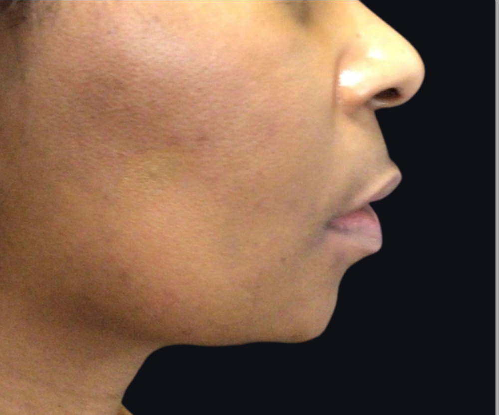 Dermal Fillers Case 7 Before Image