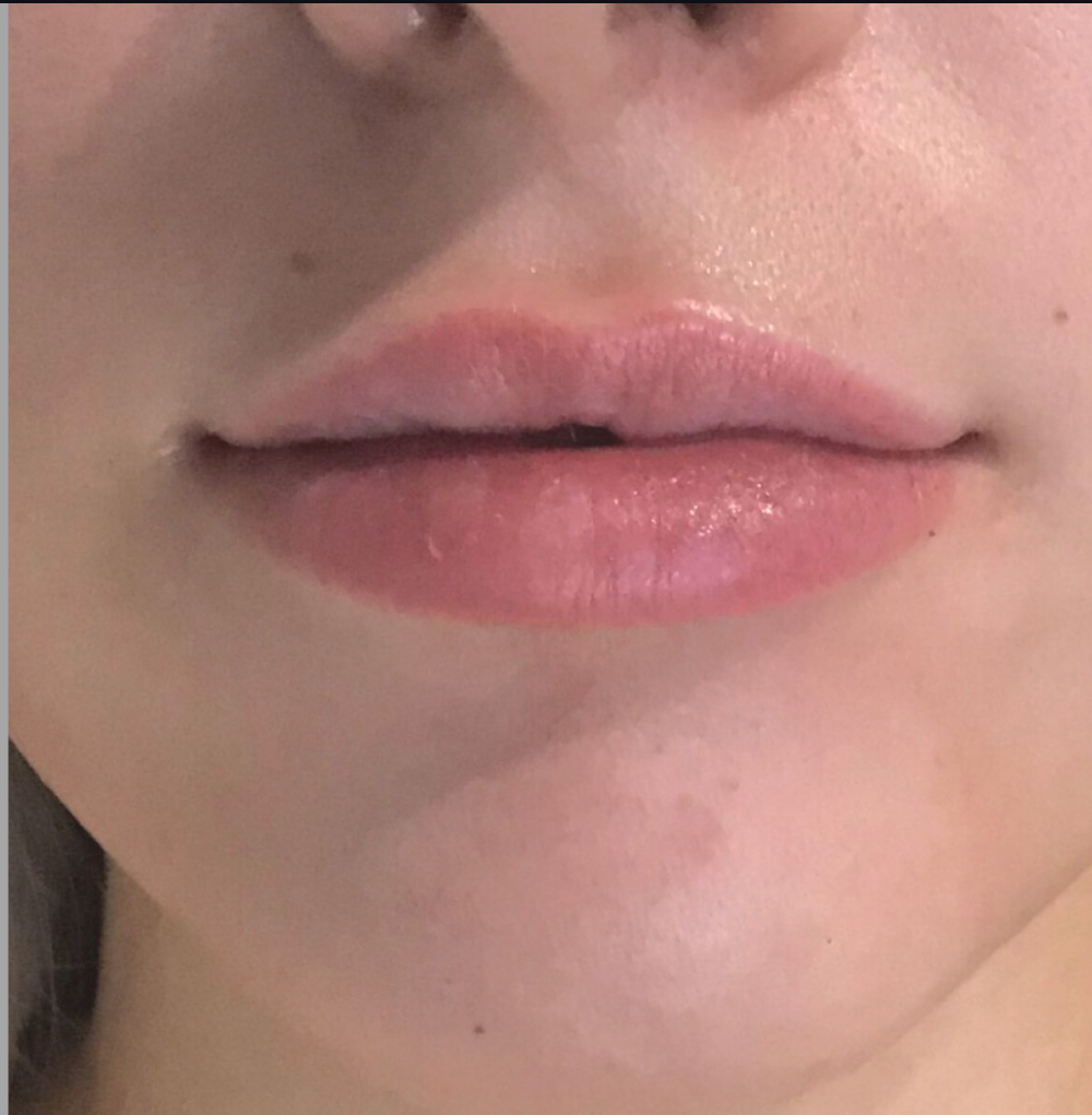 Lip Injections Case 8 After Image