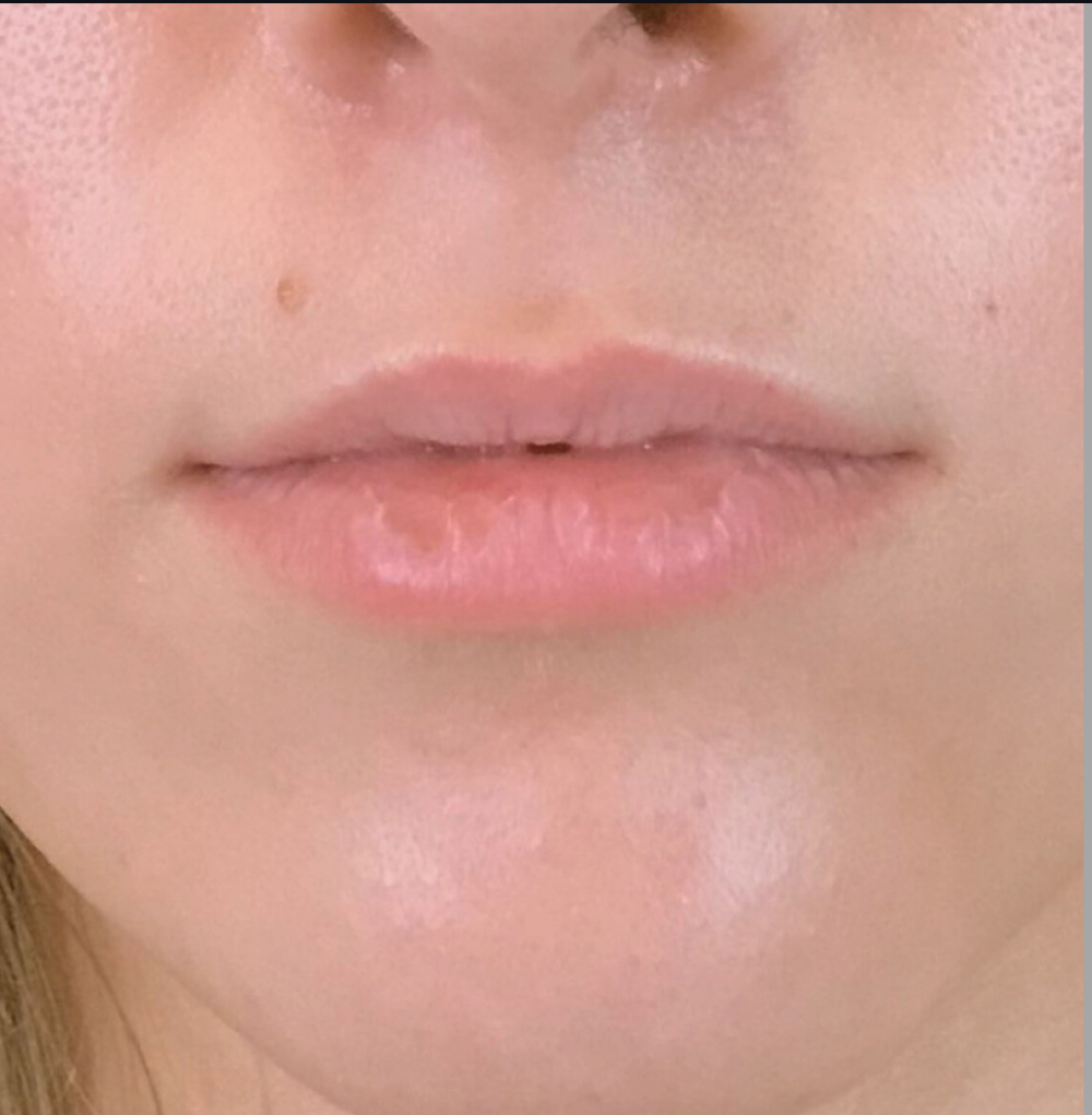 Lip Injections Case 8 Before Image