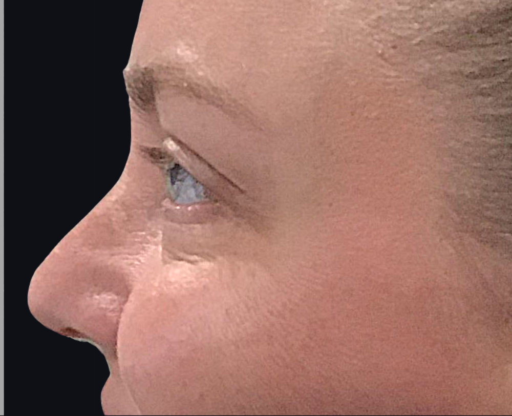 Botox® / Dysport® Case 8 After Image