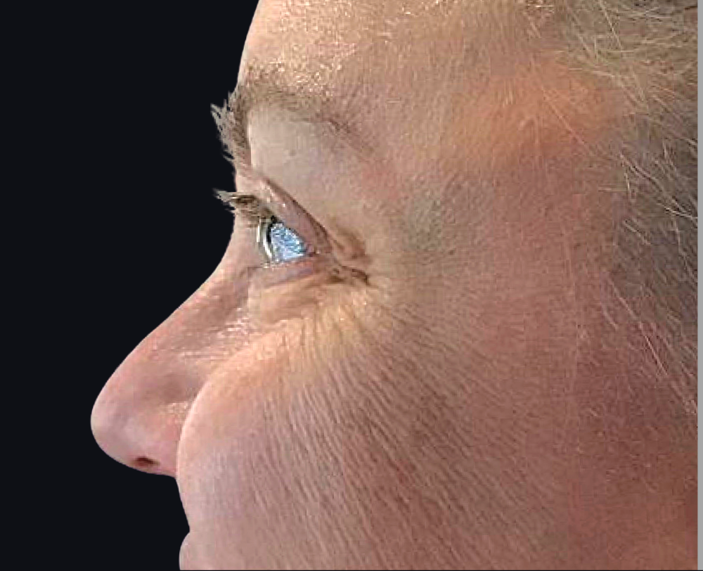 Botox® / Dysport® Case 8 Before Image