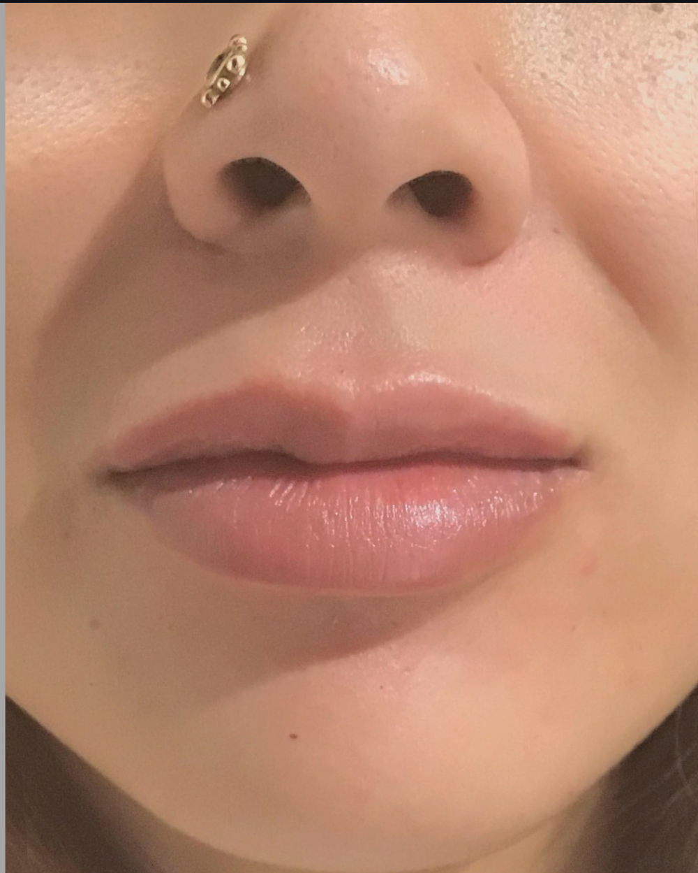 Lip Injections Case 9 After Image