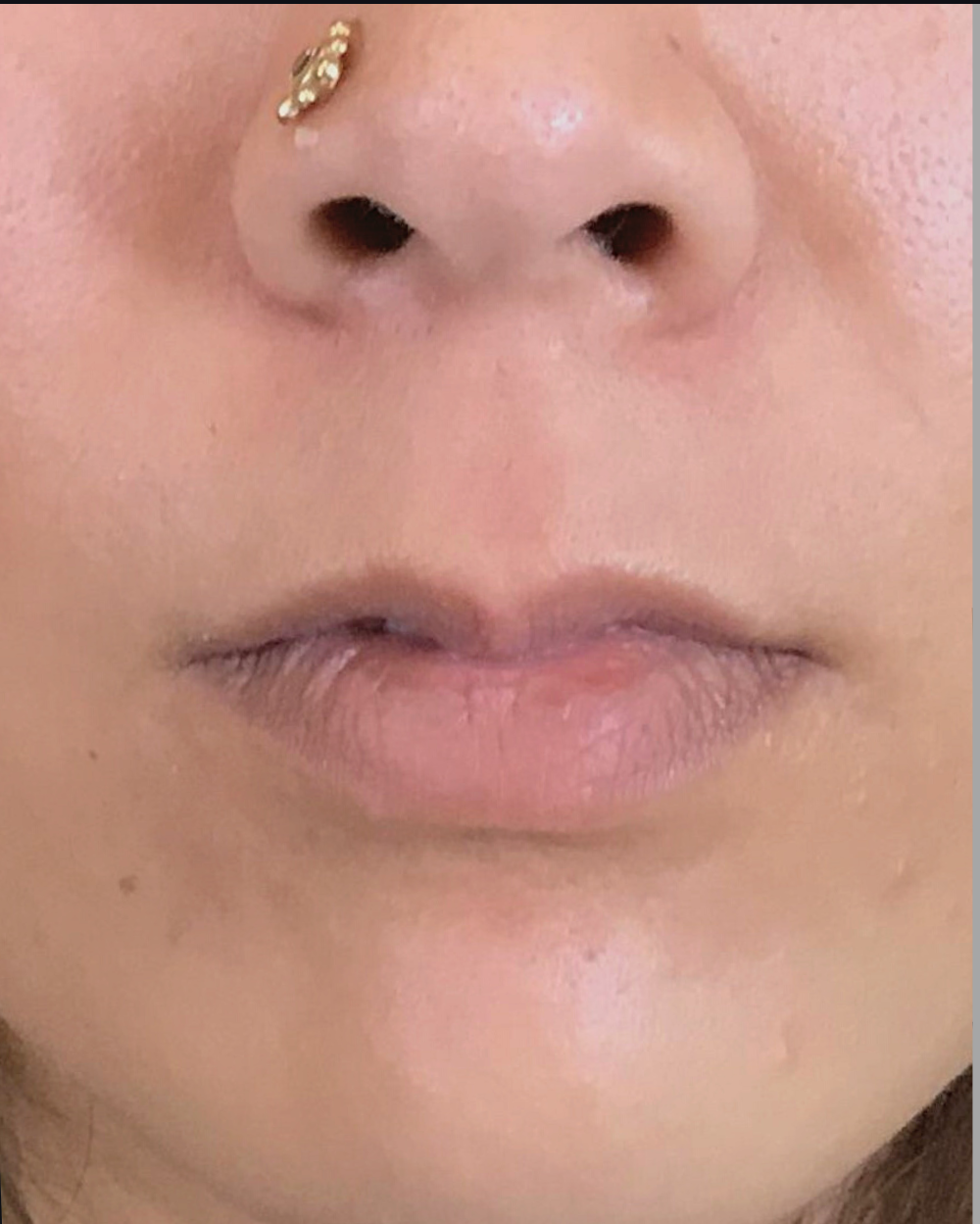 Lip Injections Case 9 Before Image