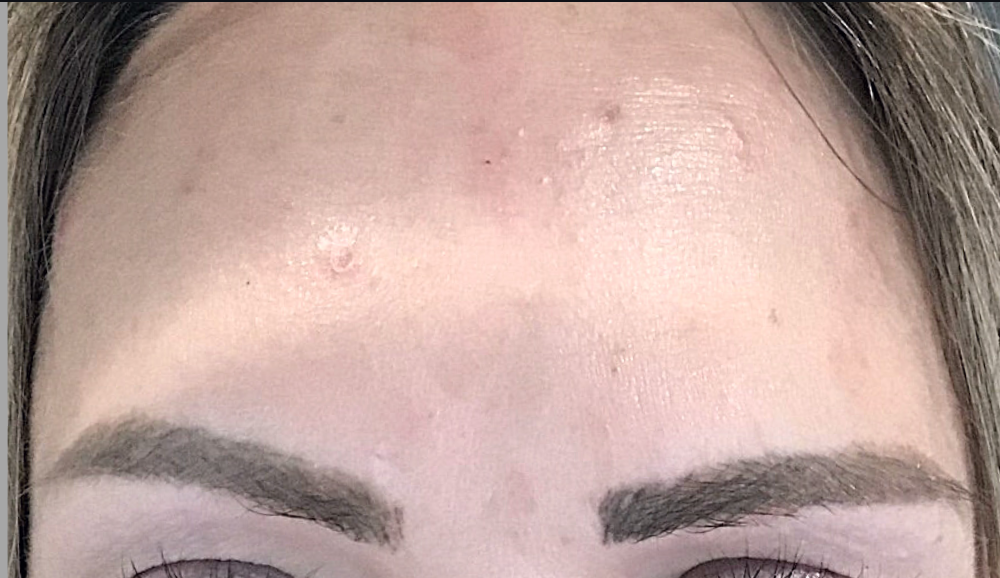 Botox® / Dysport® Case 9 After Image