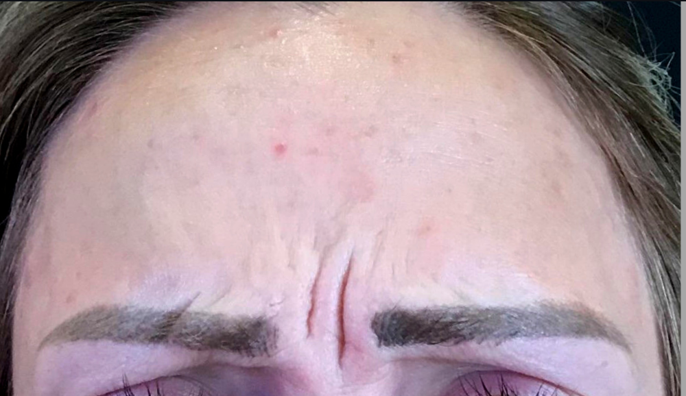Botox® / Dysport® Case 9 Before Image