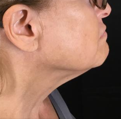Coolsculpting® ELITE Case 12 After Image
