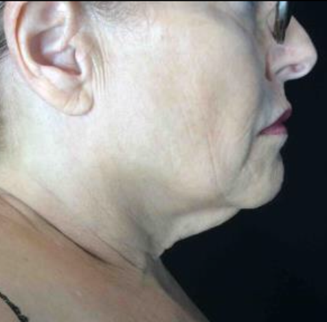 Coolsculpting® ELITE Case 12 Before Image