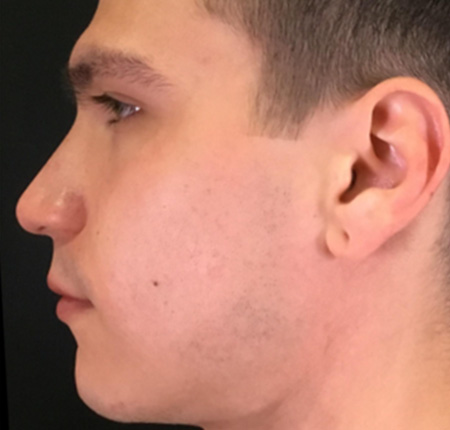Vivace Microneedling Case 5 After Image