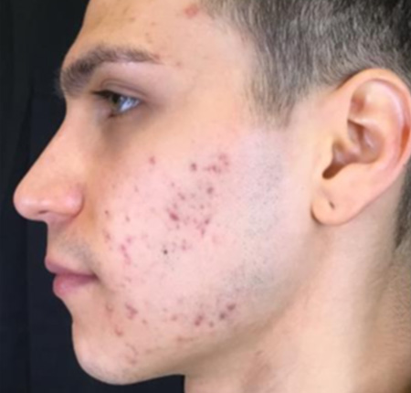 Vivace Microneedling Case 5 Before Image