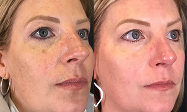 Laser Treatments Image