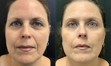 Lifting & Tightening Treatments Image