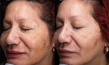 Skin Rejuvenation Treatments Image