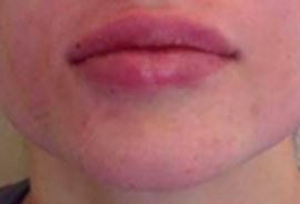 Dermal Fillers Case 73 After Image