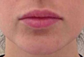 Dermal Fillers Case 73 Before Image