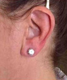 Dermal Fillers Case 23 After Image