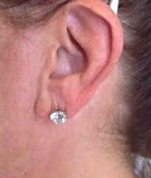 Dermal Fillers Case 23 Before Image