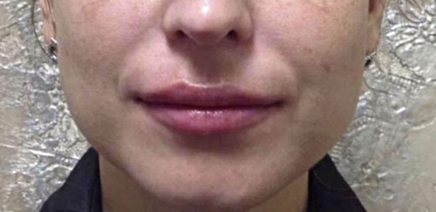 Dermal Fillers Case 72 After Image